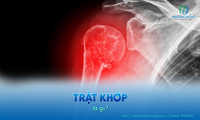 Trật khớp là gì? Triệu chứng, nguyên nhân và cách điều trị