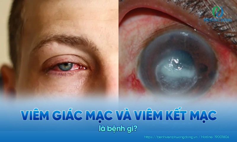 Viêm giác mạc và viêm kết mạc: Tiêu chí phân biệt và điều trị