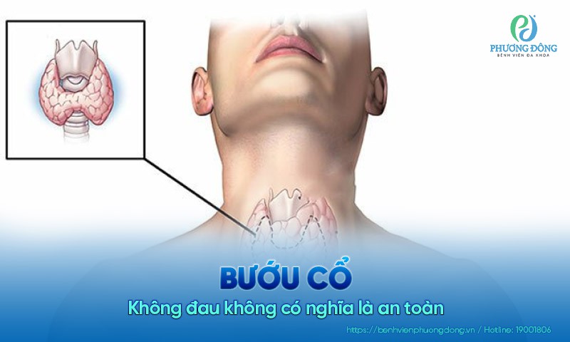 Bướu cổ: Không đau không có nghĩa là an toàn