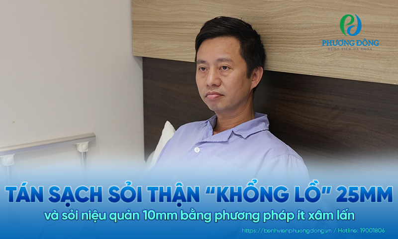Tán sạch sỏi thận “khổng lồ” 25mm và sỏi niệu quản 10mm bằng phương pháp ít xâm lấn 