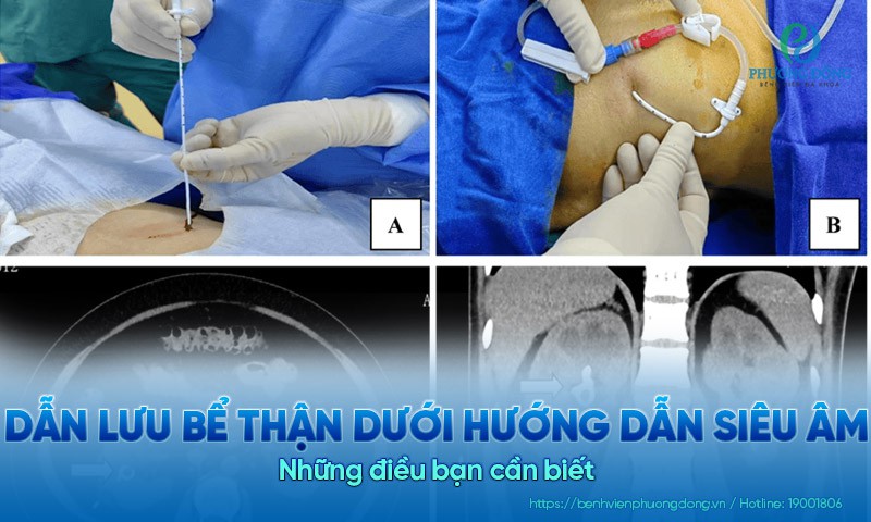 Tổng quan về kỹ thuật dẫn lưu bể thận dưới hướng dẫn siêu âm