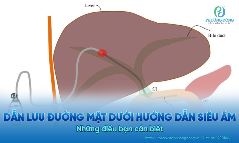 Giải thể tắc mật an toàn bằng dẫn lưu đường mật dưới siêu âm