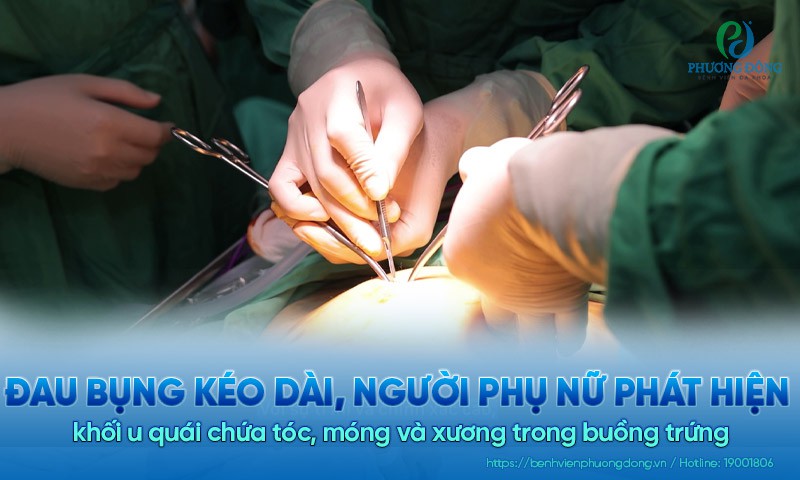 Đau bụng kéo dài, người phụ nữ phát hiện khối u quái chứa tóc, móng và xương trong buồng trứng