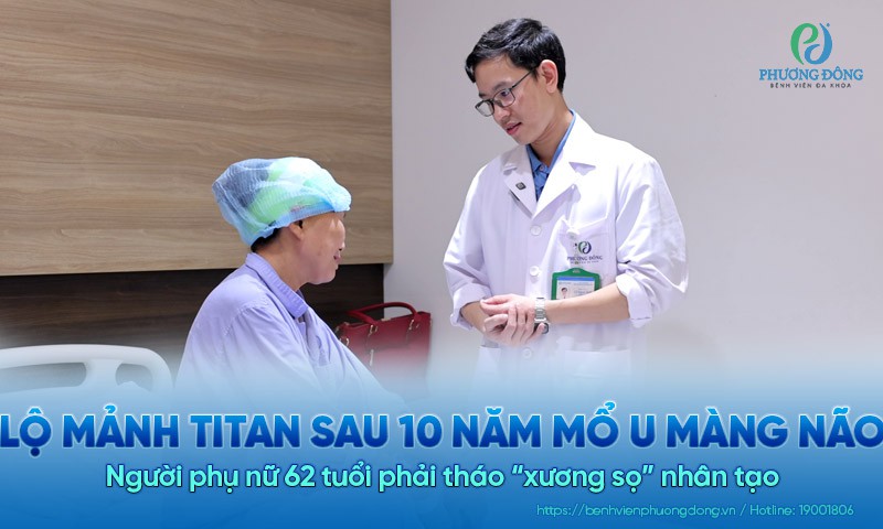 Lộ mảnh titan sau 10 năm mổ u màng não: Người phụ nữ 62 tuổi phải tháo “xương sọ” nhân tạo