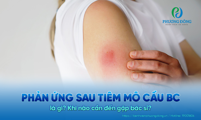 Phản ứng sau tiêm mô cầu BC là gì? Khi nào cần đến gặp bác sĩ?