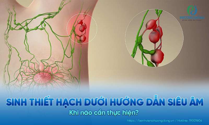 Sinh thiết hạch dưới hướng dẫn siêu âm là gì? Khi nào cần thực hiện?