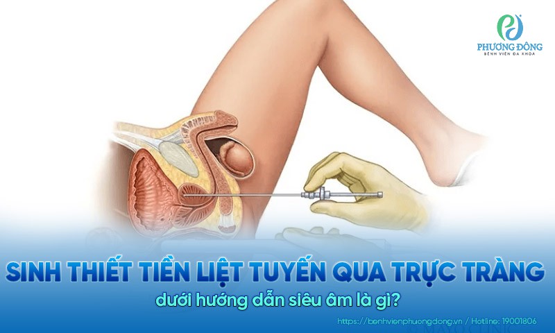 Sinh thiết tiền liệt tuyến qua trực tràng dưới hướng dẫn siêu âm là gì?