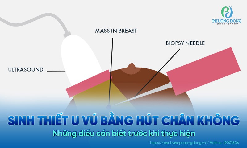 Những điều cần biết trước khi sinh thiết u vú bằng hút chân không