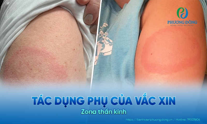 Người bệnh có thể bị sưng hoặc đỏ ở vị trí sau khi tiêm phòng
