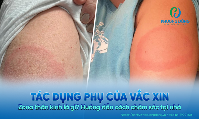Tác dụng phụ của vắc xin Zona thần kinh là gì? Hướng dẫn cách chăm sóc tại nhà 