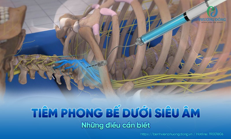 Tiêm phong bế dưới siêu âm và những điều cần biết