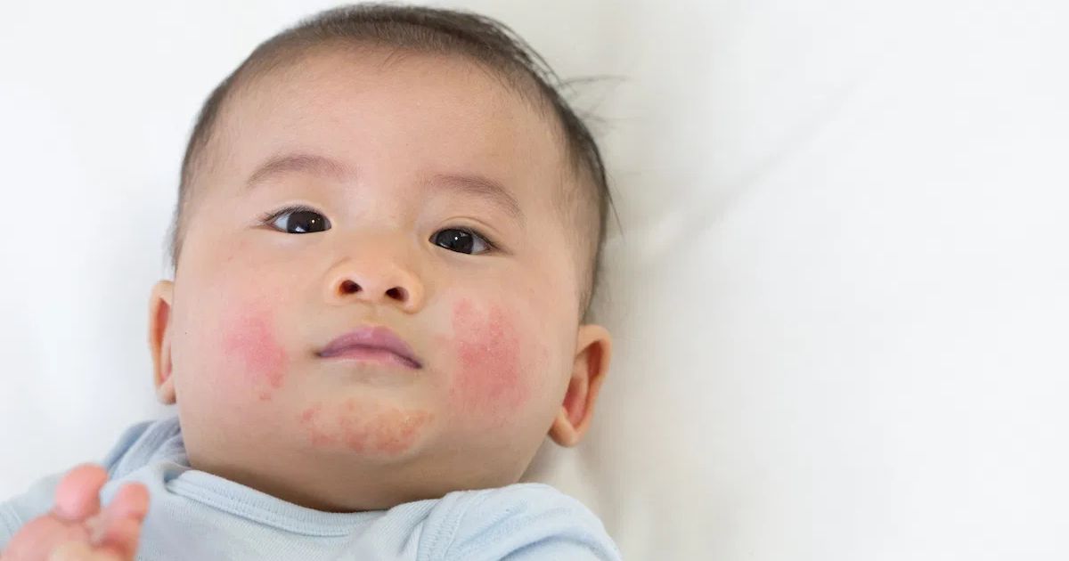 Cha mẹ nên cân nhắc thật kỹ nếu bé có cơ địa dễ dị ứng, nổi mẩn đỏ