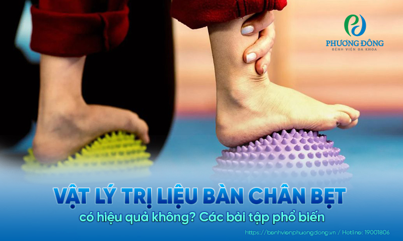 Vật lý trị liệu bàn chân bẹt có hiệu quả không? Các bài tập phổ biến 