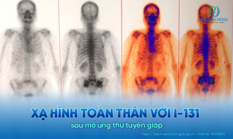 Xạ hình toàn thân với I-131 sau mổ ung thư tuyến giáp: Điều người bệnh cần hiểu để bớt hoang mang