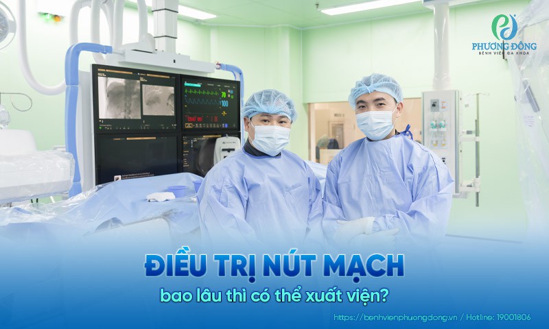 Điều trị nút mạch bao lâu thì có thể xuất viện?