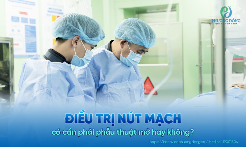 Điều trị nút mạch có cần phải phẫu thuật mở hay không?