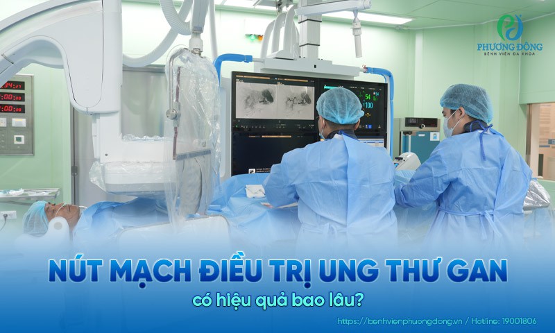 Nút mạch điều trị ung thư gan có hiệu quả bao lâu?