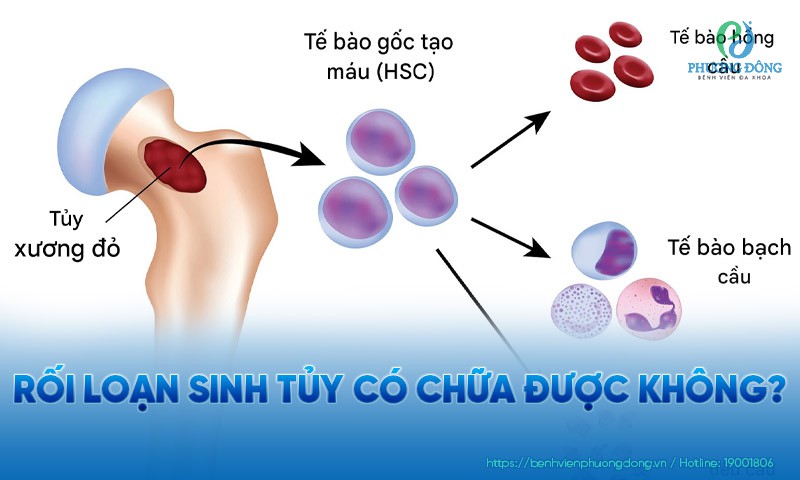 Rối loạn sinh tủy có chữa được không?