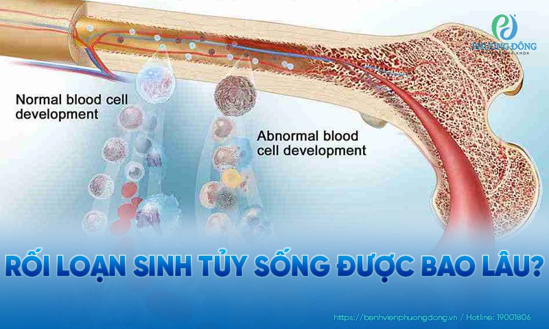 Rối loạn sinh tủy sống được bao lâu?