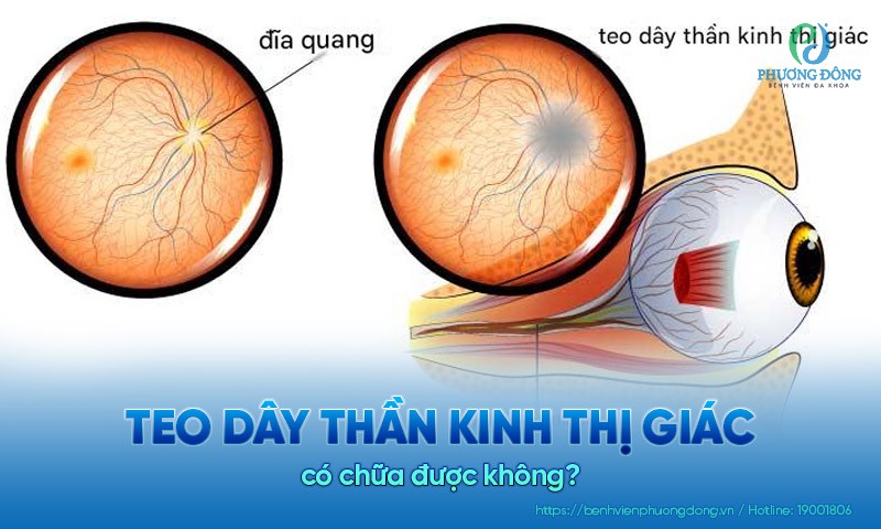 Teo dây thần kinh thị giác có chữa được không?