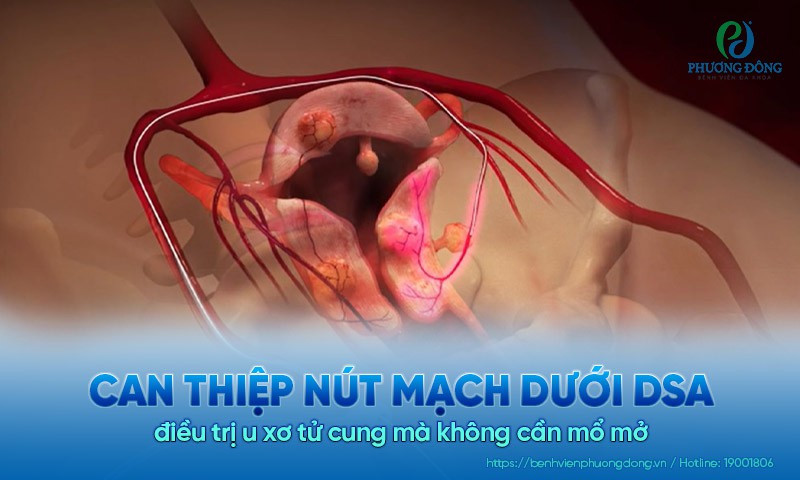 Can thiệp nút mạch dưới DSA điều trị u xơ tử cung mà không cần mổ mở