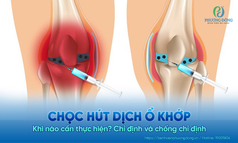 Khi nào cần chọc hút dịch ổ khớp? Chỉ định và chống chỉ định
