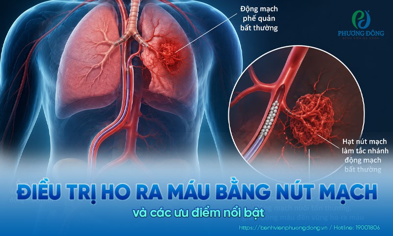 Điều trị ho ra máu bằng nút mạch và các ưu điểm nổi bật