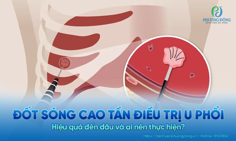 Đốt sóng cao tần điều trị u phổi: Hiệu quả đến đâu và ai nên thực hiện? 
