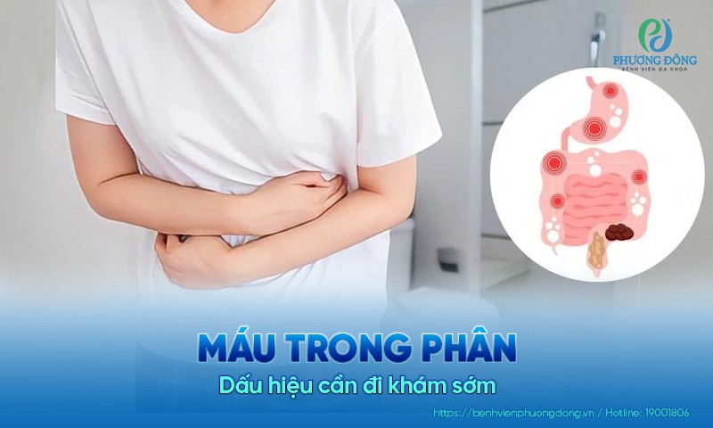 Máu trong phân: Dấu hiệu cần đi khám sớm