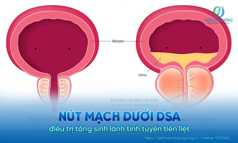 Nút mạch dưới dsa điều trị tăng sinh lành tính tuyến tiền liệt 