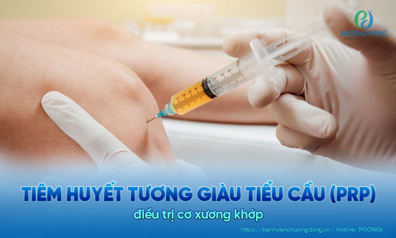 Tiêm huyết tương giàu tiểu cầu (PRP) điều trị cơ xương khớp: Chỉ định và quy trình