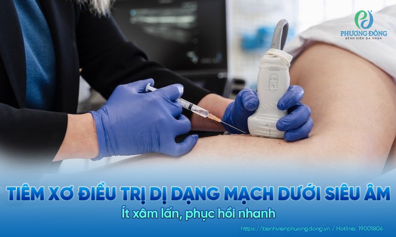 Tiêm xơ điều trị dị dạng mạch dưới siêu âm: Ít xâm lấn, phục hồi nhanh