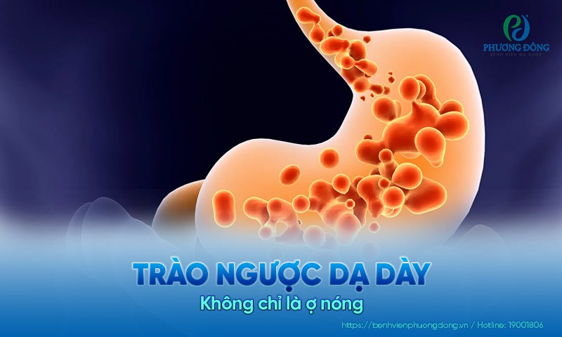 Trào ngược dạ dày: Không chỉ là ợ nóng