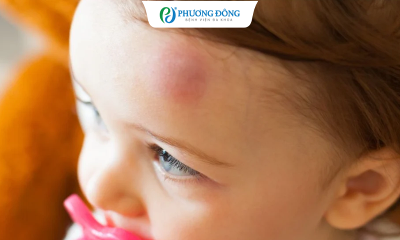 Bé bị ngã sưng ở vùng đầu bên trái có phải đi chụp CT không? 