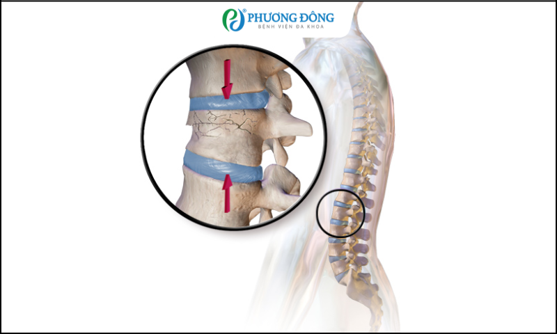 Bác sĩ cho em hỏi bị gãy D12, điều trị như thế nào?