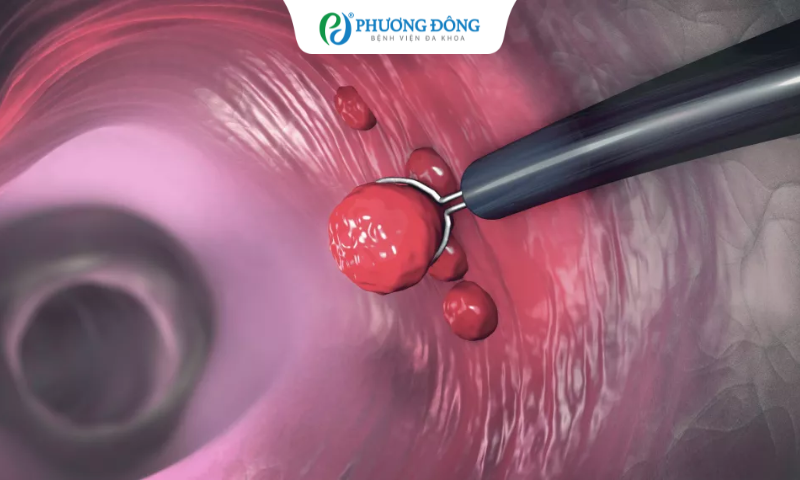 Polip cổ tử cung có nguy hiểm không