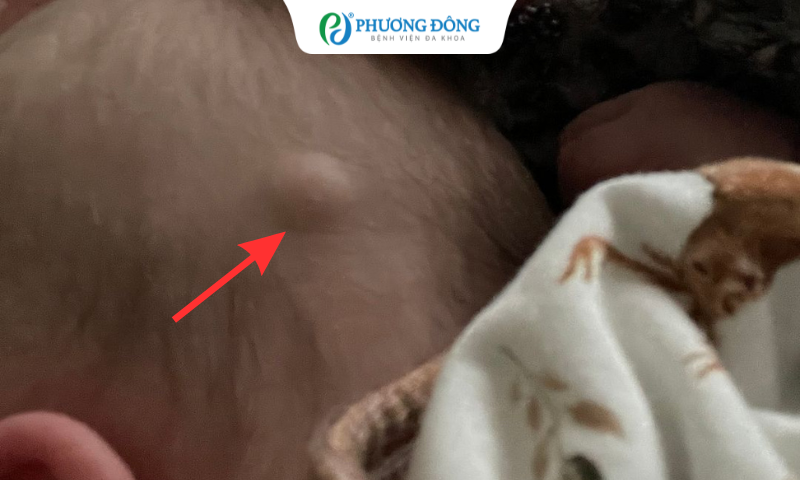 Sờ thấy nốt giống hạch phía sau đầu của trẻ có nguy hiểm không?