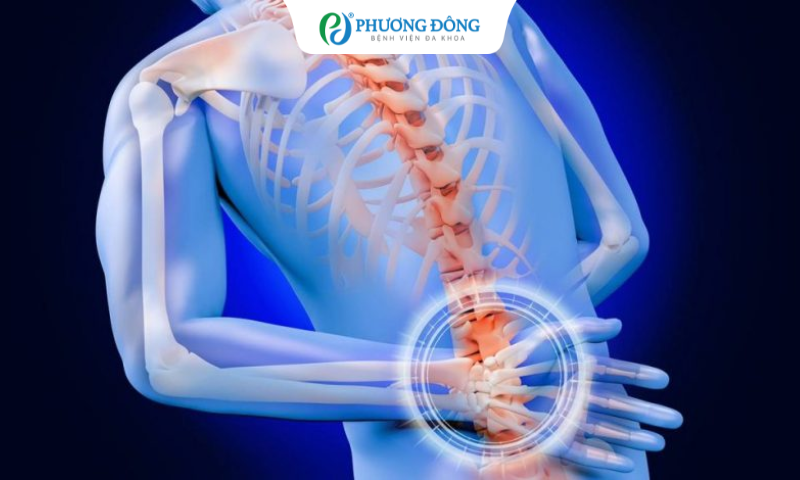 Thoát vị lưng thể trung tâm 3mm không ép rễ thần kinh