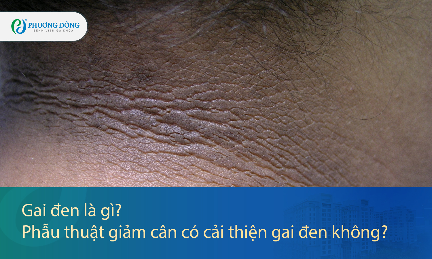 Gai đen là gì? Phẫu thuật giảm cân có cải thiện gai đen không?