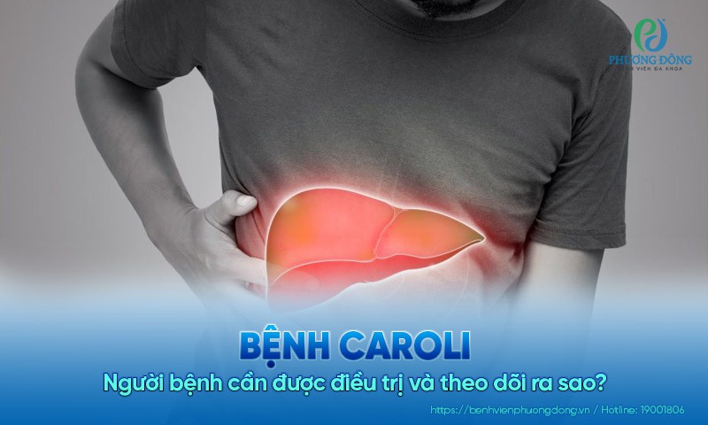 Người mắc bệnh Caroli cần điều trị và theo dõi ra sao?