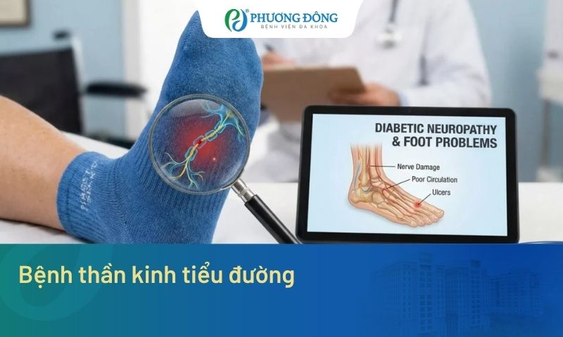 Cảm giác tê bì, châm chích ở bàn thân là biến chứng thần kinh thần kinh của bệnh tiểu đường thường gặp nhất
