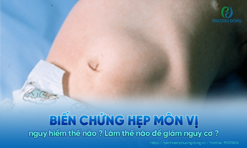 Biến chứng hẹp môn vị nguy hiểm thế nào? Làm thế nào để giảm nguy cơ?