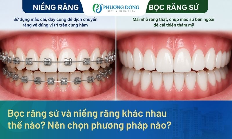 Bọc răng sứ và niềng răng khác nhau thế nào? Nên chọn phương pháp nào?