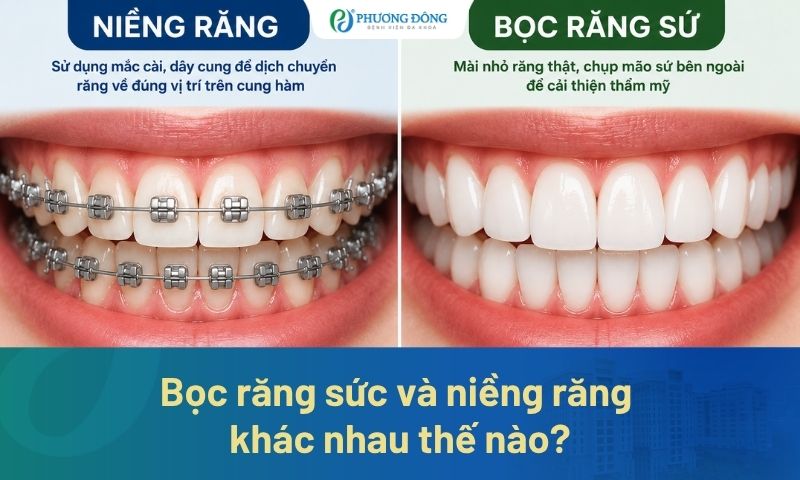 Bọc răng sứ và niềng răng khác nhau thế nào? Nên chọn phương pháp nào?
