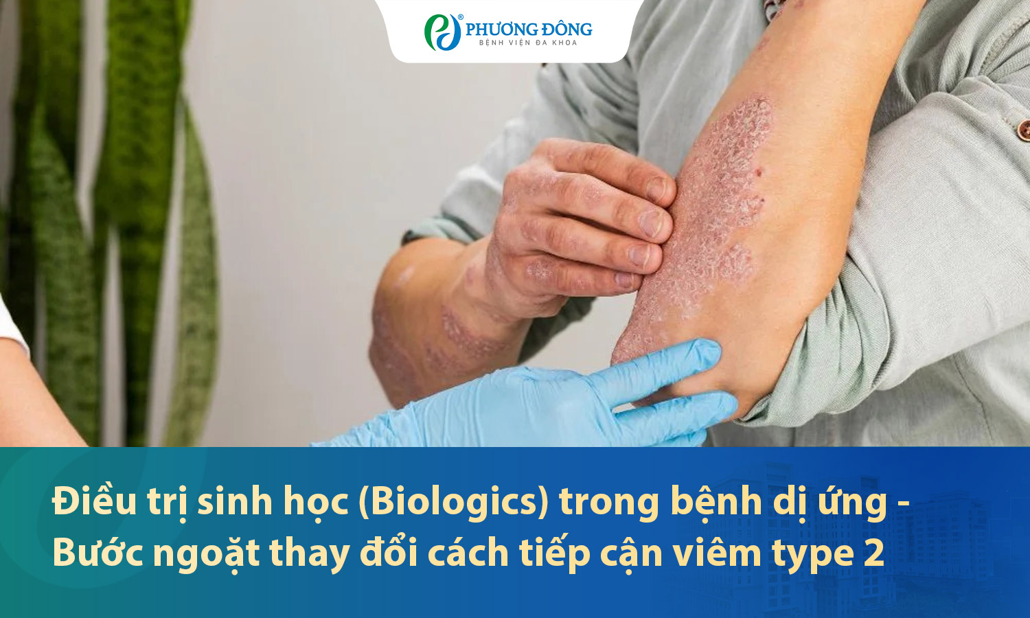 Điều trị sinh học (Biologics) trong bệnh dị ứng: Bước ngoặt thay đổi cách tiếp cận viêm type 2