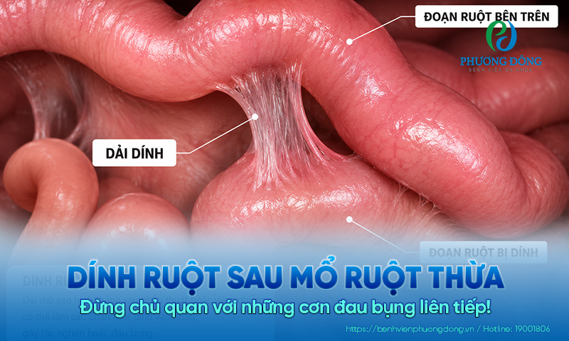 Dính ruột sau mổ ruột thừa: Đừng chủ quan với những cơn đau bụng liên tiếp!