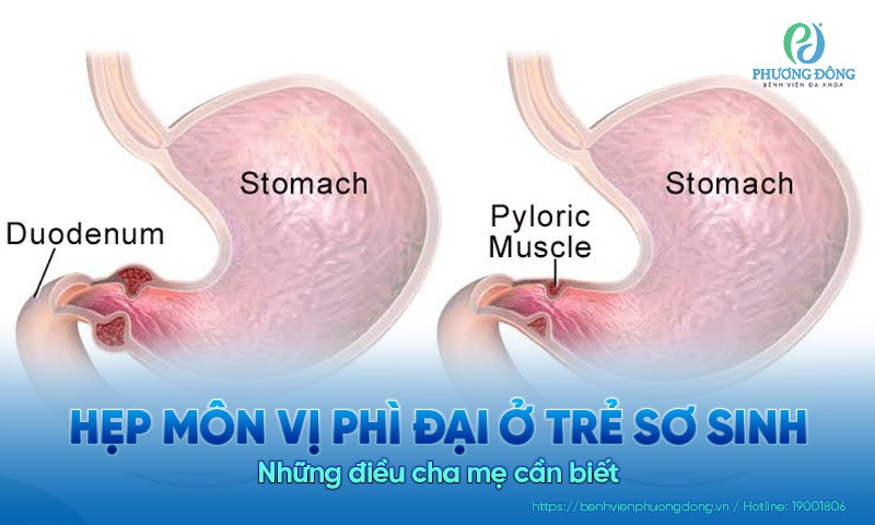 Hẹp môn vị phì đại ở trẻ sơ sinh: Những điều cha mẹ cần biết