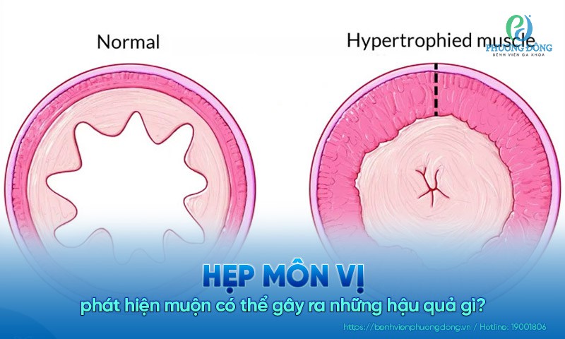 Hẹp môn vị phát hiện muộn có thể gây ra những hậu quả gì?
