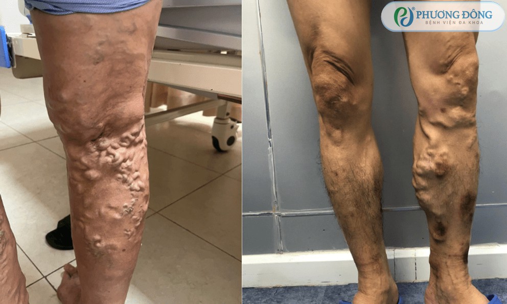 Hình ảnh thực tế đáng sợ của suy giãn tĩnh mạch chi dưới khiến nhiều người kinh hãi