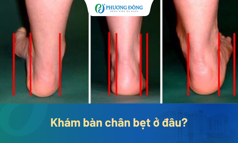 Vì sao nhiều người khám bàn chân bẹt nhưng vẫn điều trị chưa hiệu quả? 